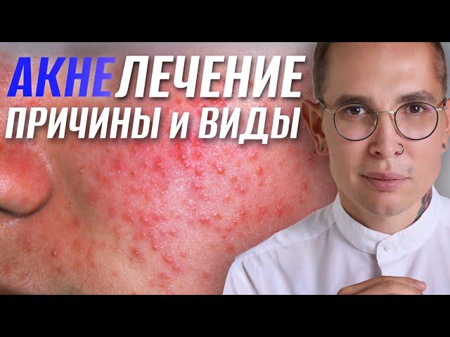 ЛЕЧЕНИЕ АКНЕ причины и виды #акне