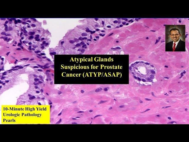 "Atypical glands suspicious for Prostate Adenocarcinoma (ATYP)" in Prostate biopsy