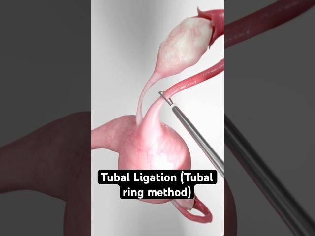 Elastic Birth Control (3D Animation)