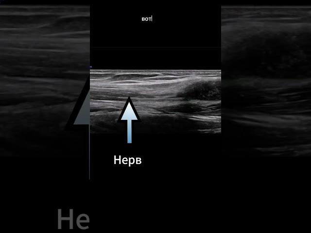 Опухоль нерва на УЗИ.