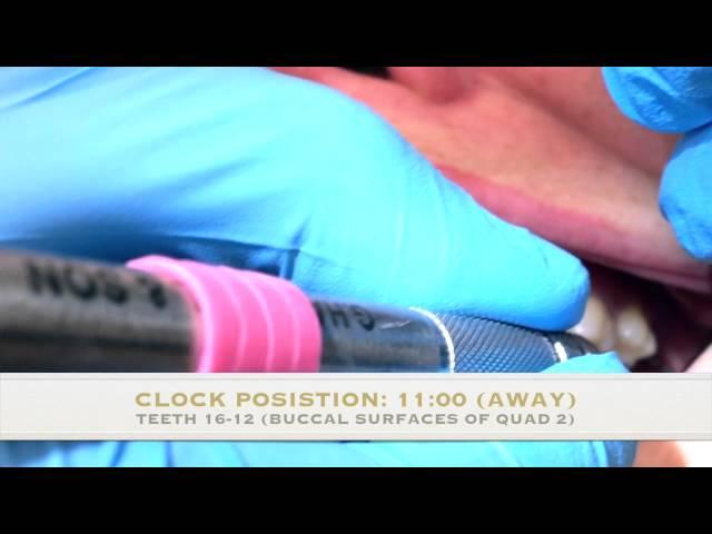 Full Mouth Probing Sequence