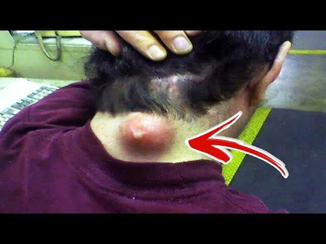 Top 10 Satisfying Pimple Popping Videos