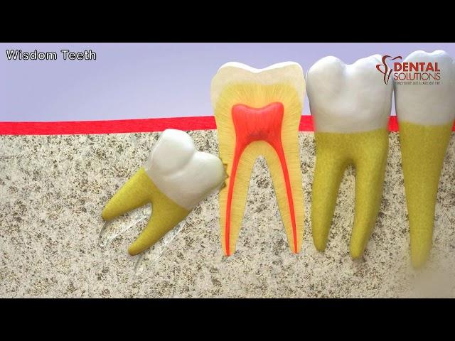 All you need to know about the eruption of a wisdom tooth