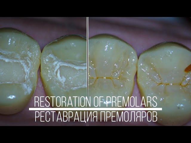 Restoration of maxillary premolars