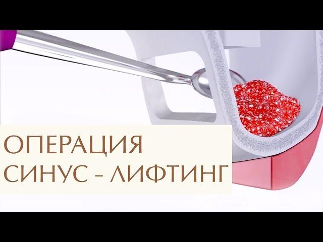  Способы наращивания костной ткани для имплантации. Наращивание костной ткани для имплантации. 12+