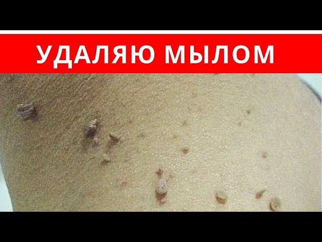 Как УДАЛИТЬ ПАПИЛЛОМЫ хозяйственным мылом