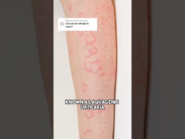 Can You Be Allergic to Water?