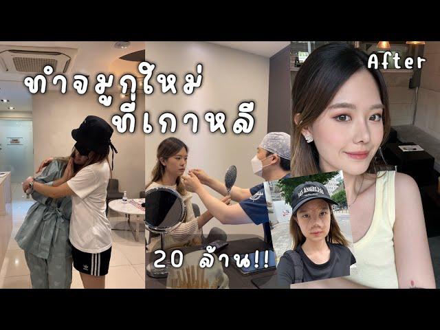 รีวิว บินไปทำจมูก ที่เกาหลี ทุกขั้นตอน เจ็บไหม? วันต่อวัน, ดูแลหลังทำ รอบนี้จบ!!