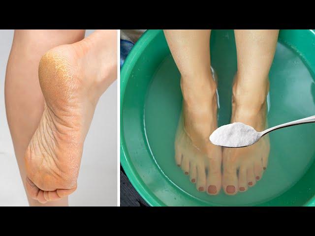 Get Rid of CRACKED HEELS Permanently - Magical Home Remedy