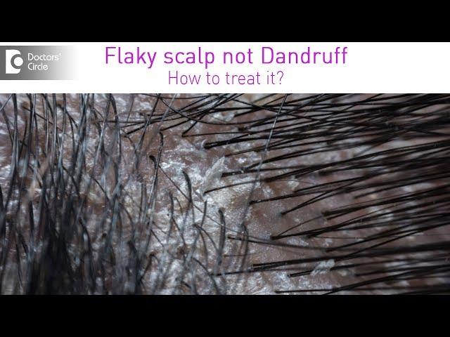 Get rid of itchy white flaky scalp which is not dandruff - Dr. Rashmi Ravindra| Doctors' Circle