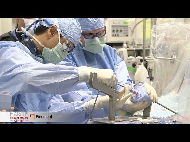 MitraClip :  Minimally Invasive Mitral Valve Repair