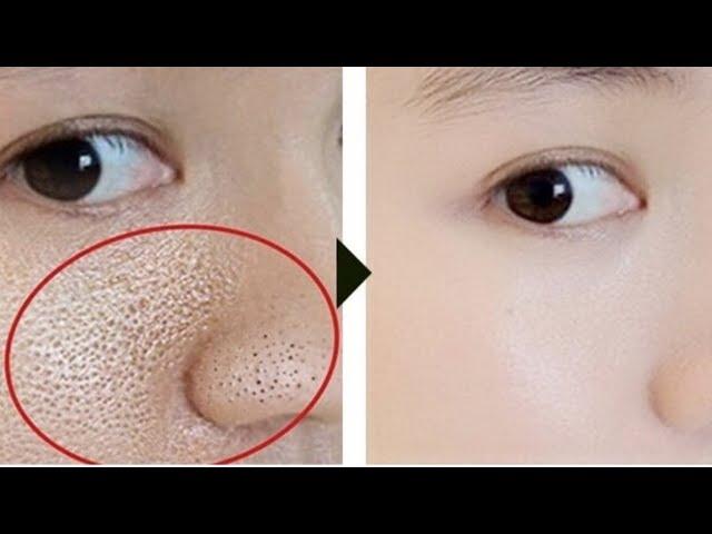 How to remove blackheads on the face