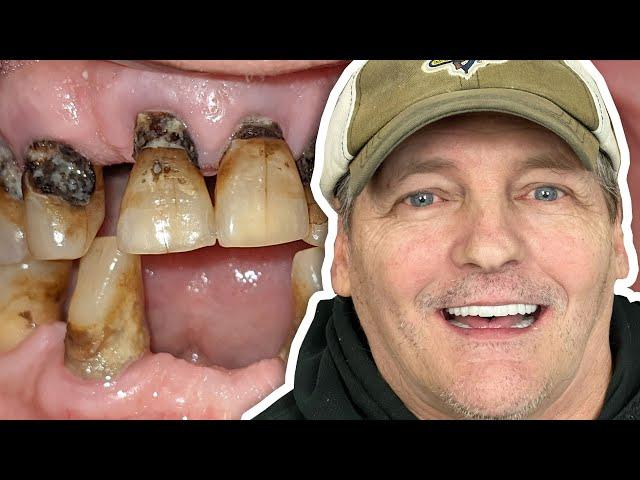3 on 6 Smile Transformation - Implant Supported Bridges instead of All-on-4