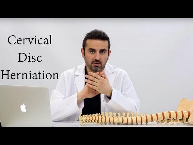 CERVICAL DISC HERNIATION