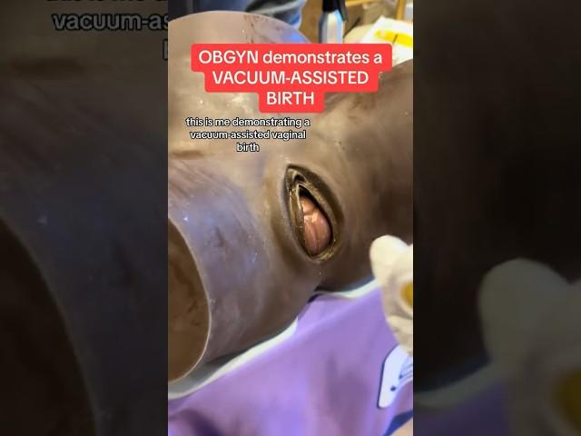 #OBGYN shows vacuum-assisted #birth. #shorts