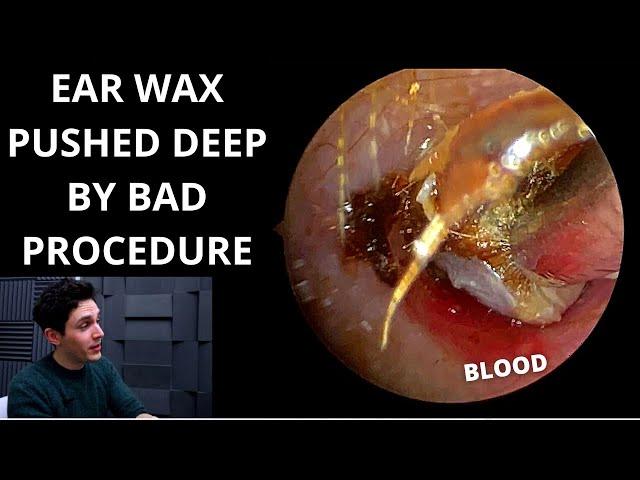 Ear Wax Pushed Down By Negligent Procedure (Ear Impressions/Mouldings)