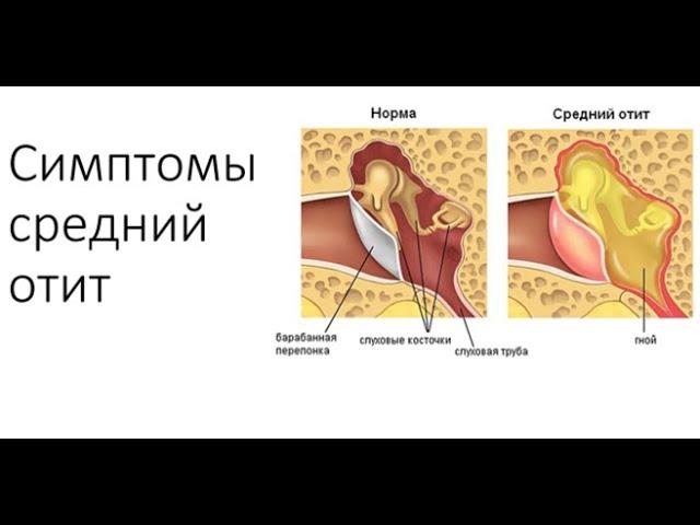 Отит симптомы. Какие симптомы мы наблюдаем при средних отитах.