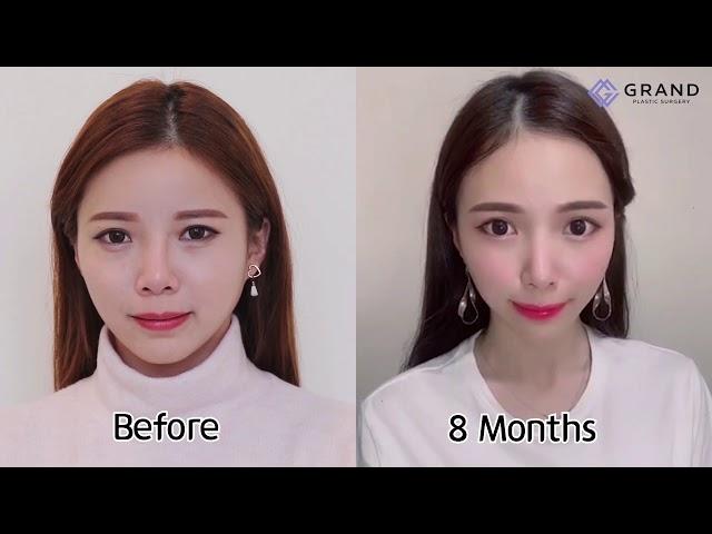 [Grand Plastic Surgery] Tip plasty/ rhinoplasty/ nose job/ revision surgery