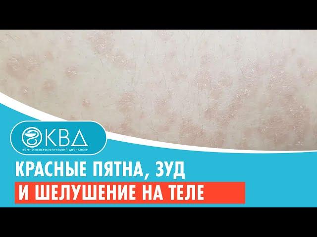  Красные пятна, зуд и шелушение на теле. Клинический случай №734