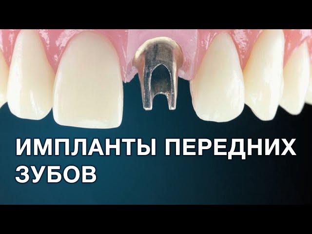 Имплантация передних зубов. Особенности протезирования.