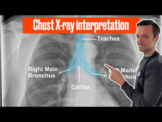 Chest X ray interpretation (in 10 minutes) for beginners #chestxray #cxr