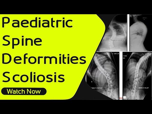 Pediatric Spine Deformities - Scoliosis | Orthopaedic Academy