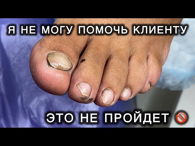 ОНА НЕ ХОЧЕТ ЭТО ИСПРАВЛЯТЬ  #толстыйноготь #онихогрифоз #экзостоз