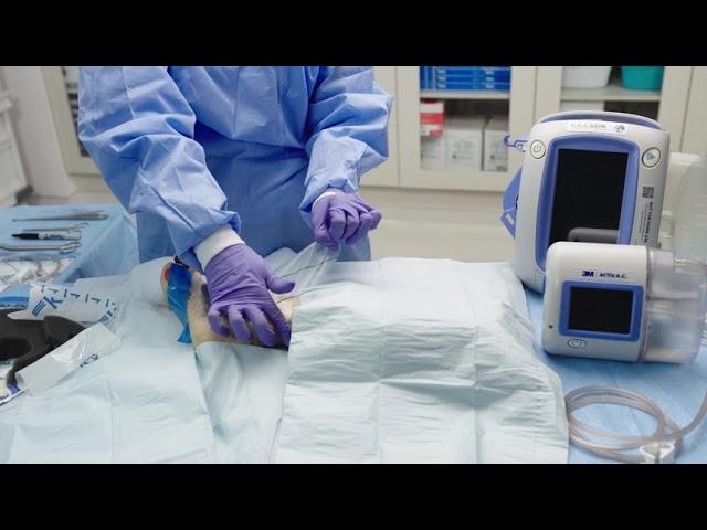 Application tips: 3M™ V.A.C.® Dressing Application Mushroom Technique on Small Wounds