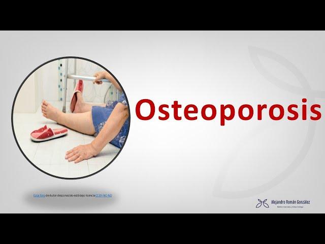 Osteoporosis post-menopáusica. Diagnóstico y tratamiento