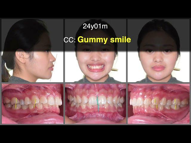 Class I Deep Bite with Gummy Smile｜【Chris Chang Ortho】CC799