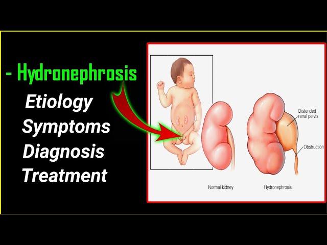 Hydronephrosis , symptoms, diagnosis and treatment @ImMEDICAL.