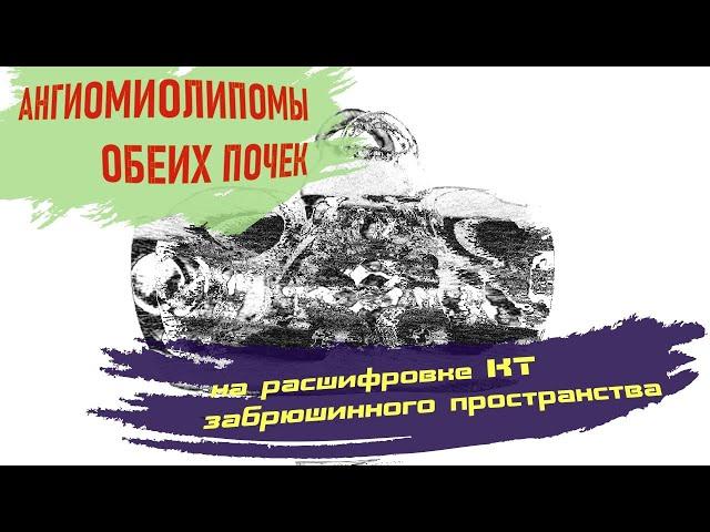 АНГИОМИОЛИПОМЫ ПОЧЕК на расшифровке КТ брюшной полости и забрюшинного пространства