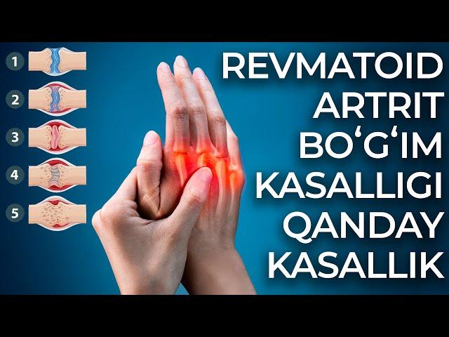 REVMATOID ARTRIT - BOʻGʻIM KASALI QANDAY KASALLIK / РEВМАТОИД АРТРИТ - БЎҒИМ КАСАЛИ ҚАНДАЙ КАСАЛЛИК