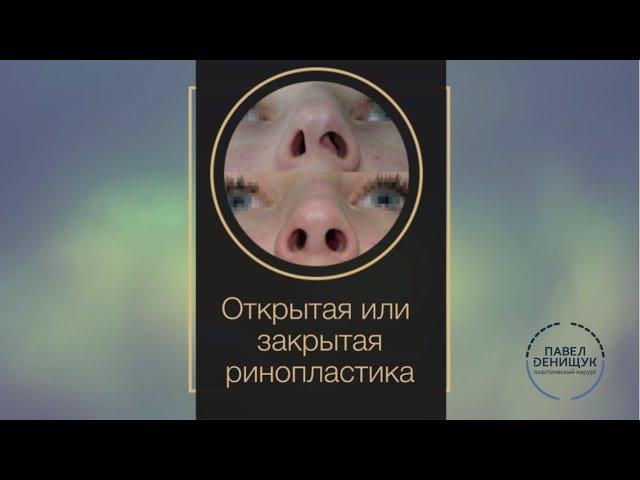 Что ЛУЧШЕ: открытая или закрытая ринопластика?