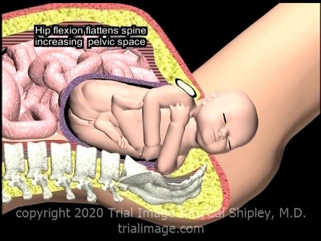 Shoulder Dystocia McRoberts Maneuver Animation by Cal Shipley, M.D.