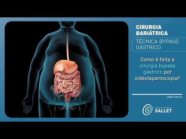 Como é realizada a técnica Bypass gástrico?