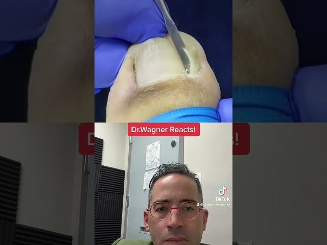 COLOSSAL INGROWN TOENAIL  #shorts #ingrowntoenail