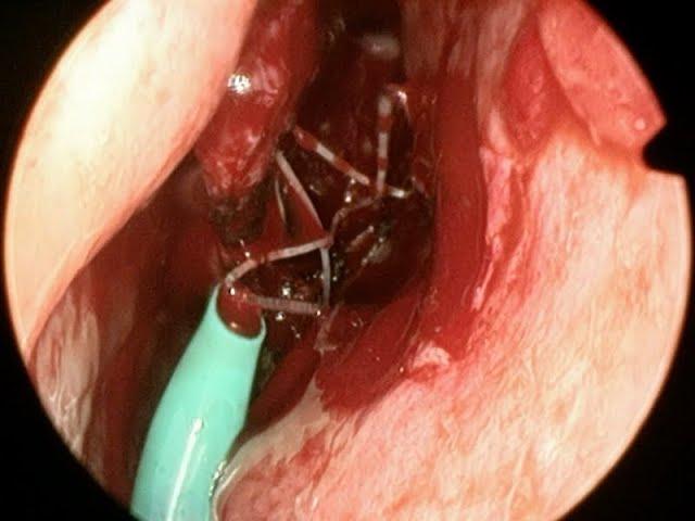 Insertion of PROPEL® Contour Implant after Sinus Surgery