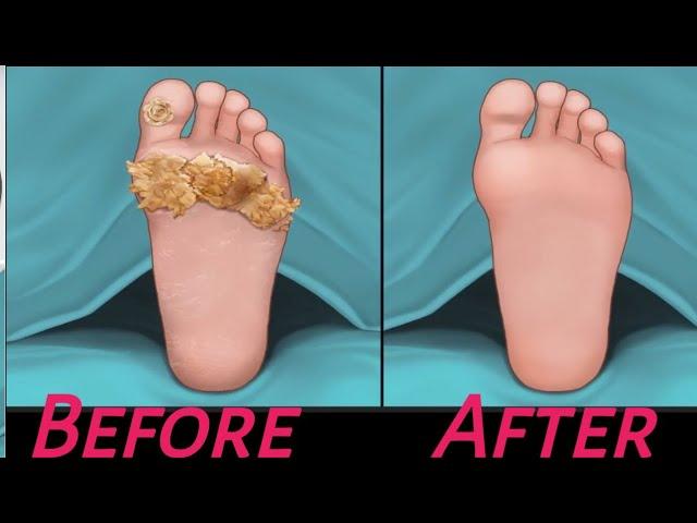 ASMR Treatment athlete's foot and warts between toes at home | Foot care animation