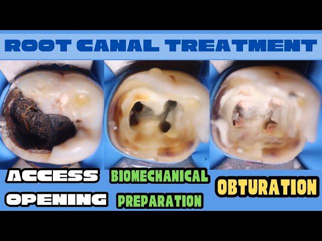 Root Canal Treatment  Mandibular Molar 🟡Access Opening🟢Biomechanical Preparation ️ Obturation