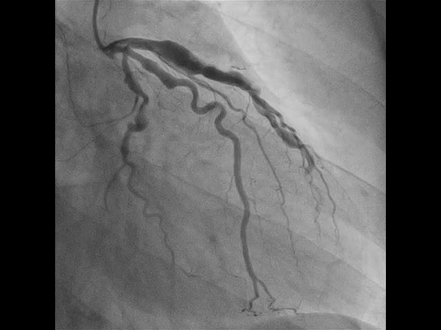 Figure 2: After management - complete resolution of obstruction and restored blood flow