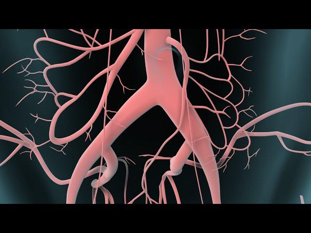 Abdominal Aortic Aneurysm