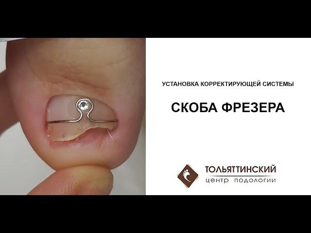 Скоба Фрезера - установка