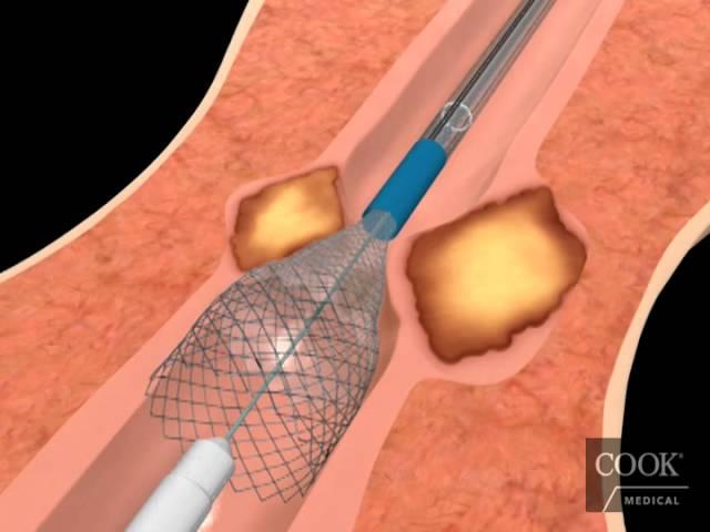 Evolution® Esophageal Controlled-Release Stent – Partially Covered Endoscopic Animation