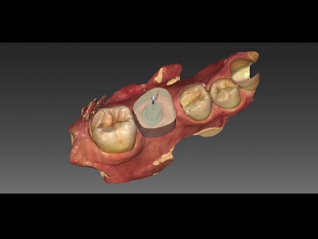 Inlab 18 implant crown