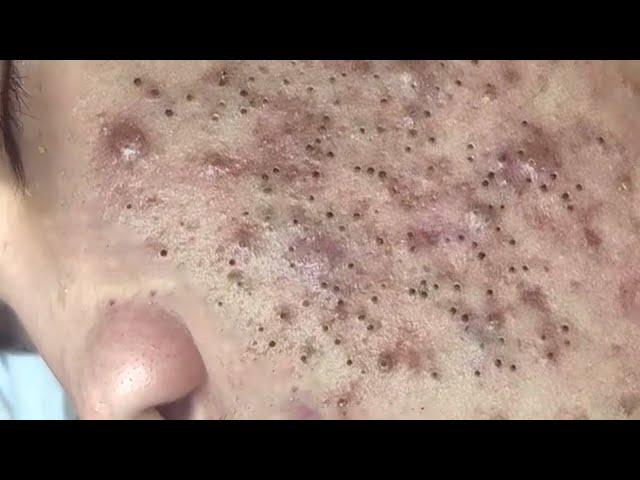 Hana #78: A blackheads field