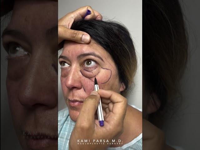 Lower Eye Bag Removal Before and After - Kami Parsa