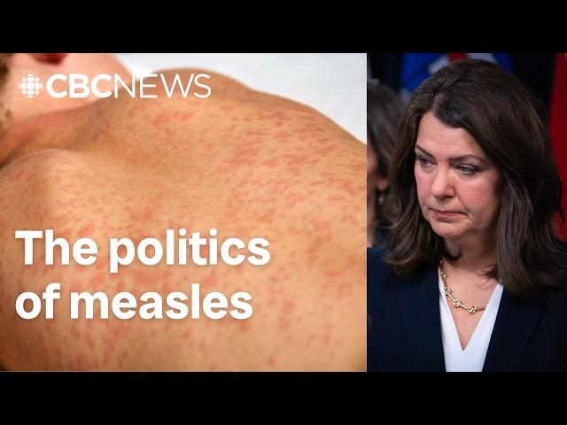 How mistrust, mixed messaging and politics influenced Alberta’s measles response