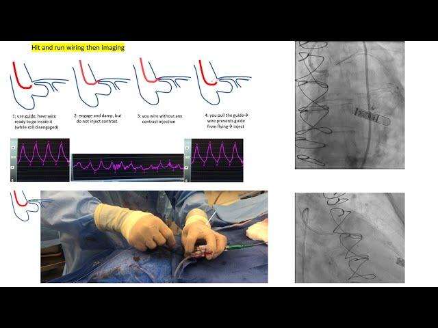 Aorto-ostial angiography and stenting: tips and tricks + case illustrations- Elias Hanna