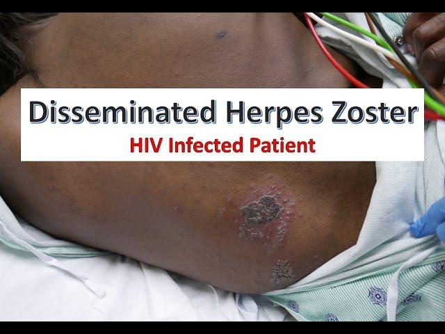 Disseminated Herpes Zoster Infection in an HIV Patient